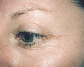 Laser Skin Resurfacing before and after photo