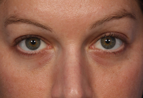 Injectable Fillers before and after photo