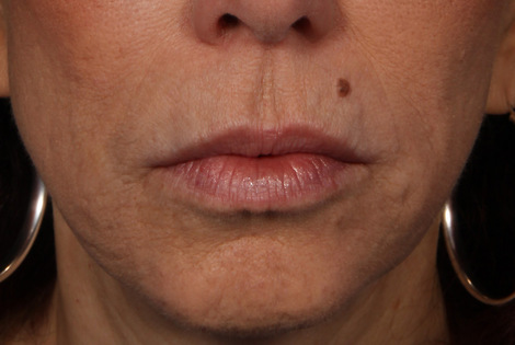 Injectable Fillers before and after photo