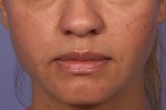 Injectable Fillers