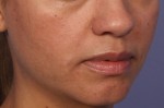 Injectable Fillers