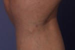 Vein Treatment Before and after photo