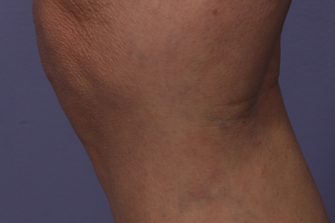 Vein Treatment before and after photo