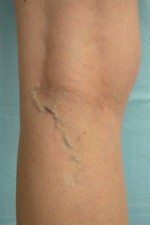 Vein Treatment