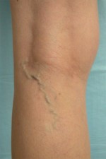 Vein Treatment