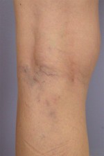 Vein Treatment