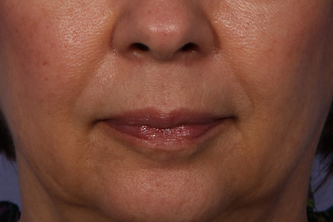 Injectable Fillers before and after photo