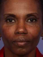 Injectable Fillers