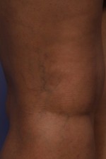 Vein Treatment Before and after photo