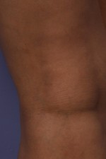 Vein Treatment