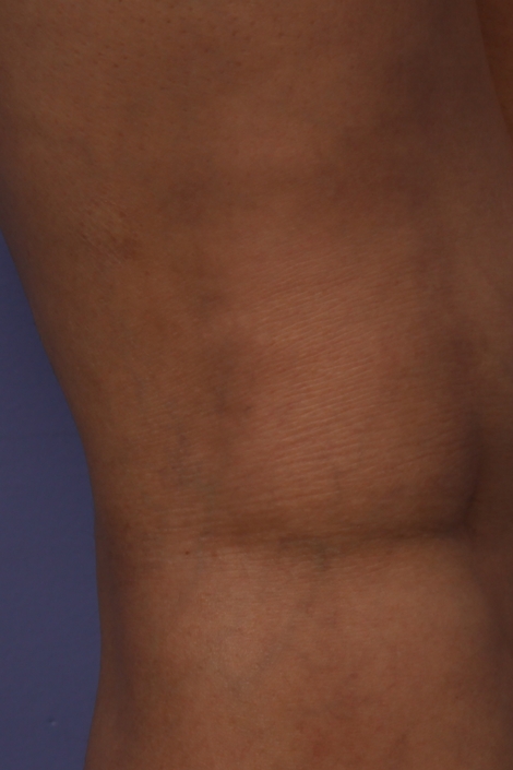 Vein Treatment before and after photo