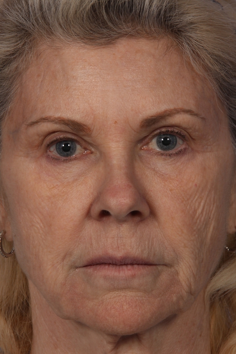 Injectable Fillers before and after photo