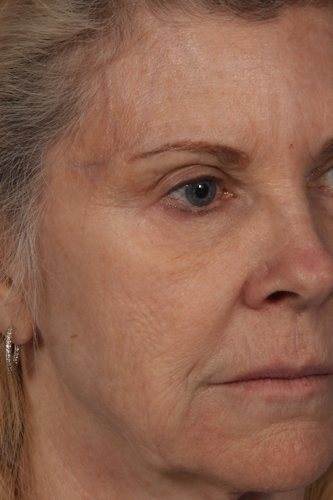 Injectable Fillers before and after photo