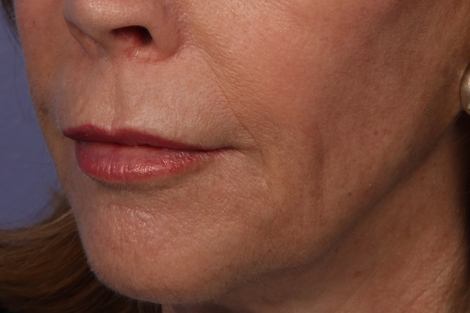 Injectable Fillers before and after photo