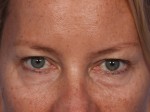 Injectable Fillers