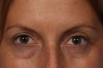 Injectable Fillers