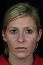 Injectable Fillers
