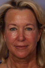 Injectable Fillers