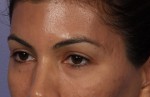 Injectable Fillers Before and after photo