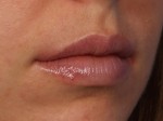 Injectable Fillers Before and after photo