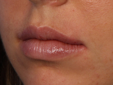 Injectable Fillers before and after photo