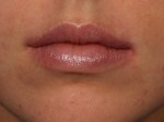 Injectable Fillers Before and after photo