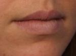 Injectable Fillers Before and after photo