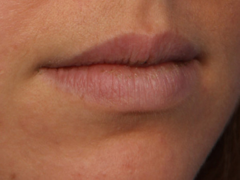 Injectable Fillers before and after photo