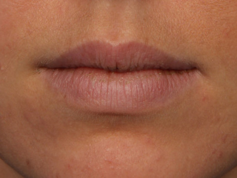 Injectable Fillers before and after photo