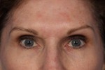 Injectable Fillers Before and after photo