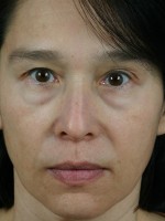 Injectable Fillers Before and after photo