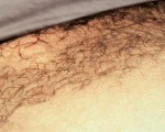 Laser Hair Removal Before and after photo