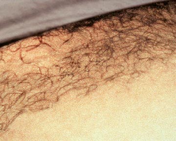 Laser Hair Removal before and after photo