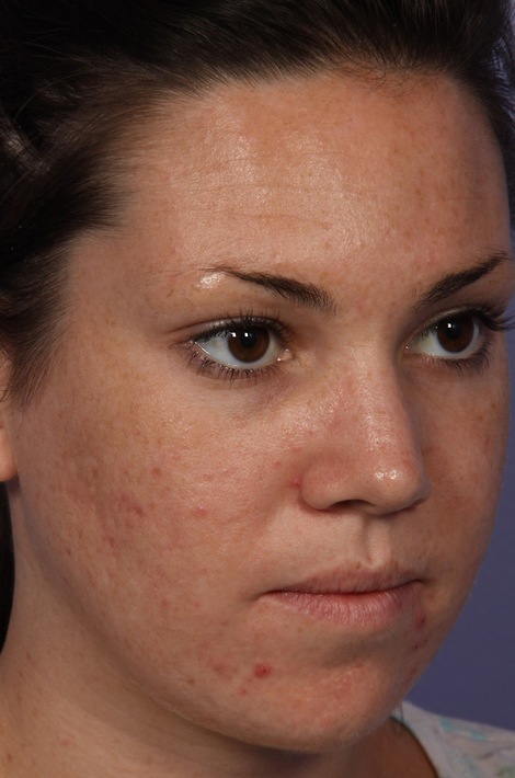 Laser Skin Resurfacing before and after photo