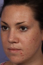 Laser Skin Resurfacing Before and after photo