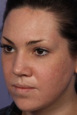 Laser Skin Resurfacing Before and after photo