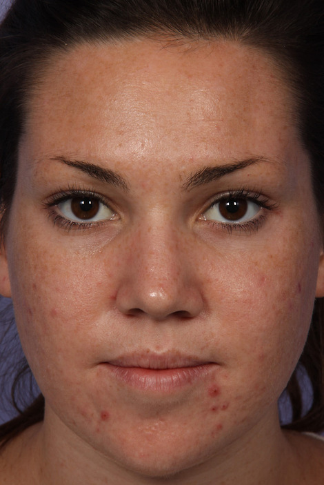 Laser Skin Resurfacing before and after photo