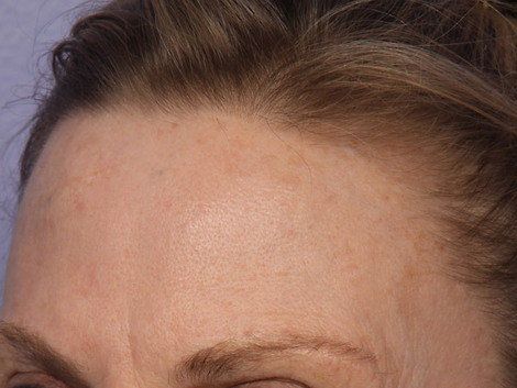 Laser Skin Resurfacing before and after photo