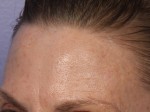 Laser Skin Resurfacing Before and after photo