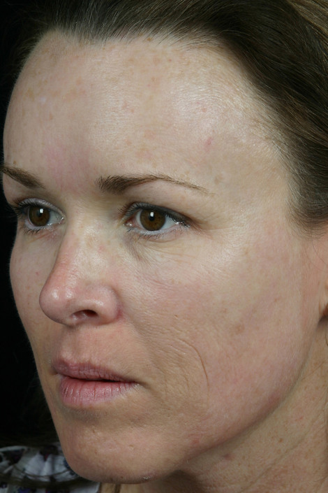 Laser Skin Resurfacing before and after photo