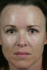 Laser Skin Resurfacing Before and after photo