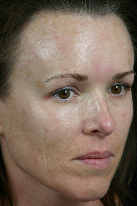 Laser Skin Resurfacing before and after photo