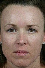 Laser Skin Resurfacing Before and after photo