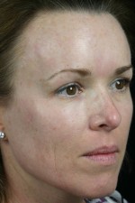 Laser Skin Resurfacing Before and after photo