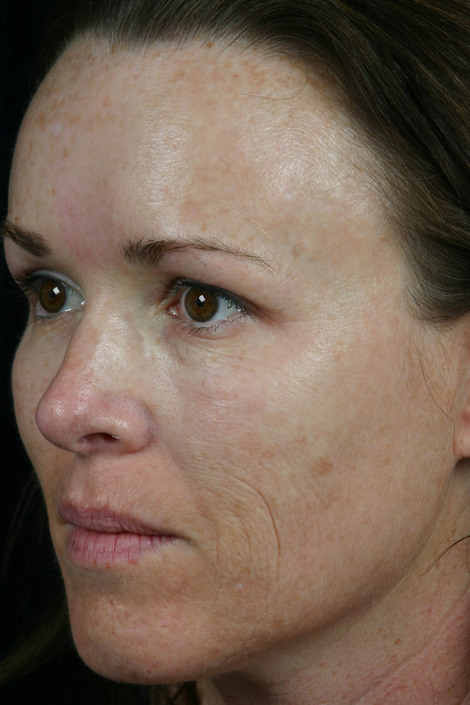 Laser Skin Resurfacing before and after photo