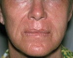 Laser Skin Resurfacing Before and after photo