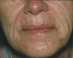 Laser Skin Resurfacing Before and after photo