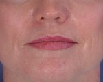 Laser Skin Resurfacing Before and after photo