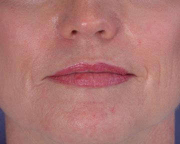 Laser Skin Resurfacing before and after photo