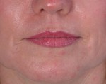 Laser Skin Resurfacing Before and after photo